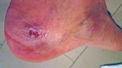 Ampoules aux pieds