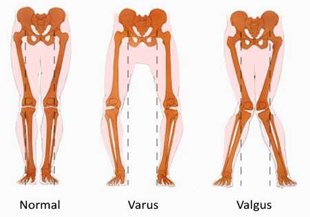 Normal, varus, valgus